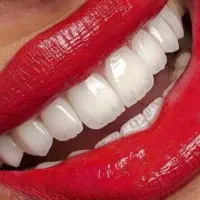 کامپوزیت دندان.لمینت دندانپزشکی. ایمپلنت.عصب کشی|خدمات آرایشگری و زیبایی|تهران, تهرانپارس جنوبی|دیوار