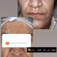 ابرسانی عمیق پوست به صورت تزریقی فقط ۱۴۰۰|خدمات آرایشگری و زیبایی|یاسوج, |دیوار