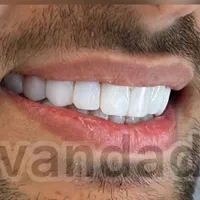 ایمپلنت لمینت کامپوزیت ارتودنسی روکش|خدمات آرایشگری و زیبایی|مشهد, سجاد شهر|دیوار