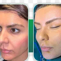 بلک فرایدی تخفیف استثنایی غبغب تزریق چربی فیلر|خدمات آرایشگری و زیبایی|تهران, دارآباد|دیوار