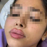 مدل جهت تزریق ژل و فیلر رایگان
