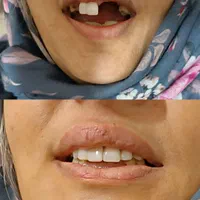 دندانسازی پیرهادی بامتد جدید کنترل لقی دندان|خدمات آرایشگری و زیبایی|ورامین, ورامین|دیوار