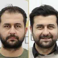 کاشت موی تضمینی با خط رویش 100٪ طبیعی|خدمات آرایشگری و زیبایی|شهرکرد, |دیوار