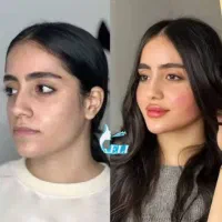 جشنواره تخفیف ۵۰٪ ژل و فیلر تمام برندها از ۵۰۰