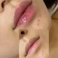 تزریق ژل و آنزیم غبغب وبینی وتزریق آنزیم تخلیه ژل|خدمات آرایشگری و زیبایی|اردبیل, |دیوار