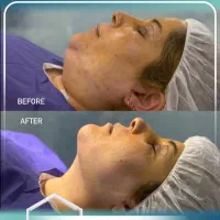 ساکشن غبغب/تزریق چربی/بلفاروپلاستی توسط متخصص