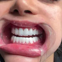 کامپوزیت دندان|خدمات آرایشگری و زیبایی|بوشهر, |دیوار