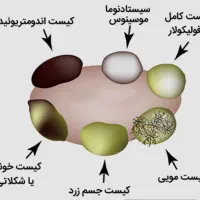 دفع کیست وفیبرم ودرمان عفونت بانوان
