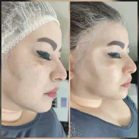مدل فیشیال وی ای پی و درمان جوش|خدمات آرایشگری و زیبایی|تهران, مجیدیه|دیوار
