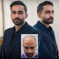 کاشت مو - کلینیک نوین ایرانا