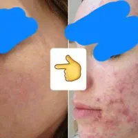 مشکلات پوستیی پسوریازیس لک و...تضمینی|آرایشی، بهداشتی، درمانی|اردبیل, |دیوار