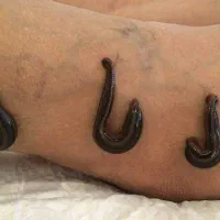 درمان‌ ریشه‌ای با طب سنتی حجامت وزالودرمانی