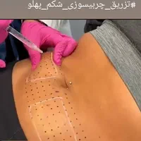 تزریق ژل بوتاکس چربیسوزی آنزیم جوانسازی|خدمات آرایشگری و زیبایی|اهواز, کیانپارس |دیوار