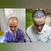 کاشت مو باتخفیف ویژه، یا(اقساطی)|خدمات آرایشگری و زیبایی|شیراز, معالی‌آباد|دیوار