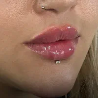 تزریق ژل و بوتاکس جشنواره