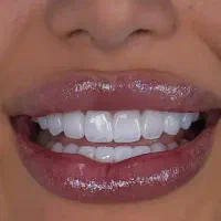 ۱۵درصد تخفیف روی خدمات ایمپلنت به مدت محدود|خدمات آرایشگری و زیبایی|تبریز, |دیوار