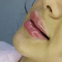 ژل ـ لب ـ گونه و... بوتاکس. آنزیم|خدمات آرایشگری و زیبایی|قم, تولید دارو و یخچال|دیوار