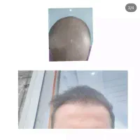 کاشت مو|خدمات آرایشگری و زیبایی|سلماس, |دیوار