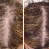 درمان  ریزش مو