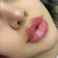 تزریق تخصصی ژل لب با تخفیف ۵۰ درصدی فیلر لب