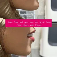 ژل وبوتاکس فیلرمزوپی ارپی آنزیم هایفوبلفاروپلاستی|خدمات آرایشگری و زیبایی|تبریز, |دیوار