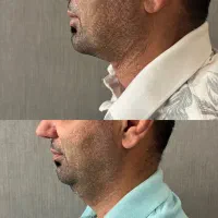 تخلیه غب غب|خدمات آرایشگری و زیبایی|خرم‌آباد, |دیوار