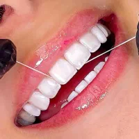 لمینیت ونیر روکش طلا بریج اندو جرمگیری کامپوزیت