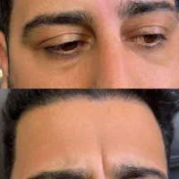 کاشت نخ چربی سوز امبدینگ ،ژل وبوتاکس|خدمات آرایشگری و زیبایی|قم, نیروگاه|دیوار