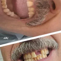 ساخت دندان مصنوعی اقتصادی با خدمات در منزل|خدمات آرایشگری و زیبایی|ری, دیلمان|دیوار