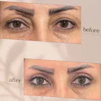 مشاوره تخصصی رایگان فیلر،بلفارو،غبغب..باتخفیف ویژه