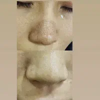 پارافین تراپی پلکسر  کوچیک کردن بینی برداشتن خال|خدمات آرایشگری و زیبایی|قم, نیروگاه|دیوار