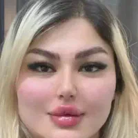 تخفیف تزریق فیلرلب،بادی،بیکینی،بوتاکس،توسط پزشک