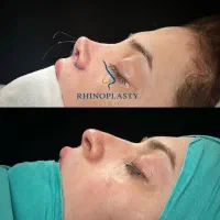 عمل زیبایی بینی (قسطی)|خدمات آرایشگری و زیبایی|تهران, مطهری|دیوار