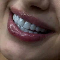 کامپوزیت تخفیف ویژه بهاره