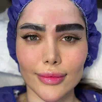 کاشت مو و ابرو پرتراکم طبیعی.اقساطی