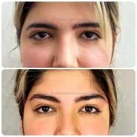 جراحی پلاستیک و تخصصی لیفت شقیقه و دایرکت ابرو