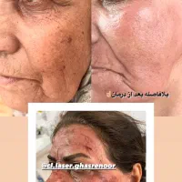 درمان تخصصی لک و هایفو جشنواره تخفیف50% در شیراز، ملاصدرا
