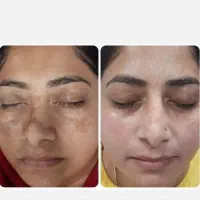 لک صورت و جوانساز ملاسما جوش چروک اصل