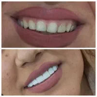 کامپوزیت زیبایی دندان درکلینیک دندانپزشکی|خدمات آرایشگری و زیبایی|یاسوج, |دیوار