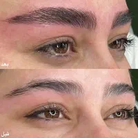 انجام خدمات میکرو فیبروز و شیدینگ لب