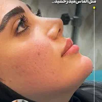 *جشنوااره خدمات تخصصی لیزر ، تزریق فیلر و بوتاکس|خدمات آرایشگری و زیبایی|اصفهان, هزارجریب|دیوار