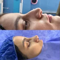 جراحی زیبایی بینی صفرتاصد ۲۹تومان متخصص(ent)|خدمات آرایشگری و زیبایی|تهران, یوسف‌آباد|دیوار