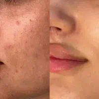 دیگرنگران جوشهای صورتت نباش