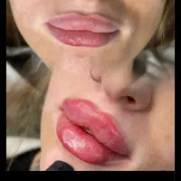 ژل لب گونه چونه زاویه مادلینگ راویه سازی|خدمات آرایشگری و زیبایی|قم, تولید دارو و یخچال|دیوار
