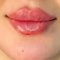 آموزش و خدمات ژل و بوتاکس ومزو