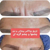 آموزش خدمات زیبایی  تزریق ژل .فیلر .بوتاکس .چربی
