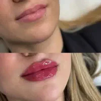 ژل فیلر بوتاکس فیلر بادی کانتورینگ