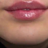 جشنواره بوتاکس ، ژل ، پی آرپی ، جوانساز