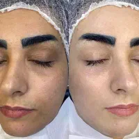 پاکسازی پوست 150