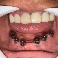 ایمپلنت دیجیتال اقساطی بدون سود در انواع برندها|خدمات آرایشگری و زیبایی|شیراز, زرگری|دیوار